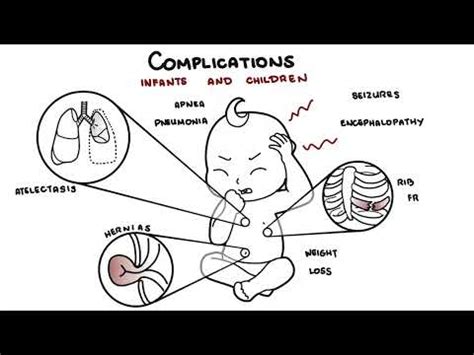 What is Pertussis and Whooping Cough? - Bordetella Pertussis Symptoms, Pathophysiology and ...