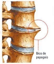 Cot Cl Nica Sempre Sa De Tel Osteofitose Ou Bico De