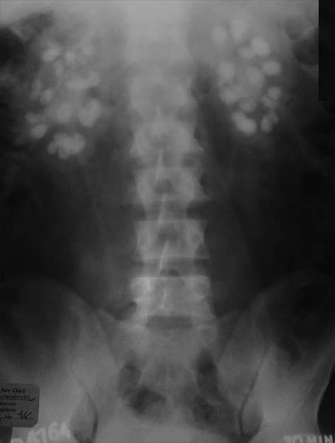 Filex Ray Abdomen Bilateral Nephrocalcinosis Embryology