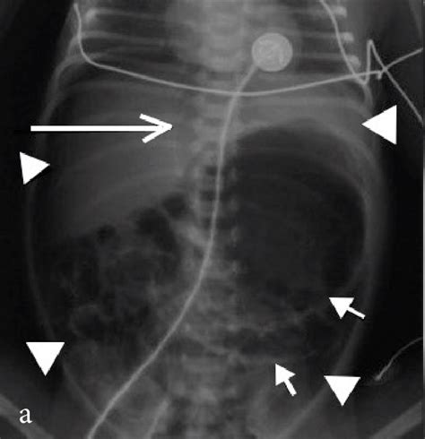 A Supine Abdominal Radiograph Demonstrating Rigler S Sign Closed Download Scientific Diagram