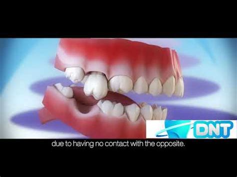 Consequences Of Not Replacing Missing Teeth Youtube