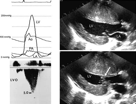 Hypertrophic Obstructive Cardiomyopathy Circulation Research