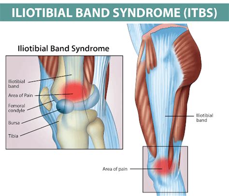 Iliotibial Band It Band Syndrome It Band Syndrome Is It Band