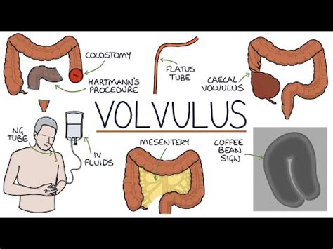 Learn Understanding Volvulus Twisted Bowel Mind Luster