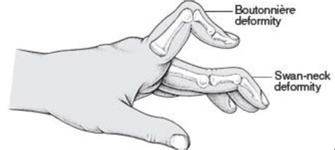 [solved] 3 Draw And Describe Swan Neck Deformity And Boutonniere Deformity Course Hero