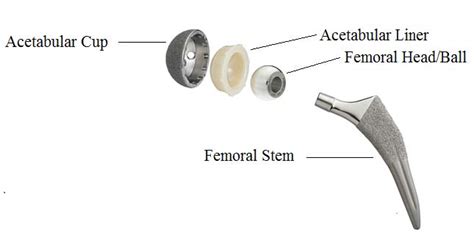 Hip Joint Prosthesis