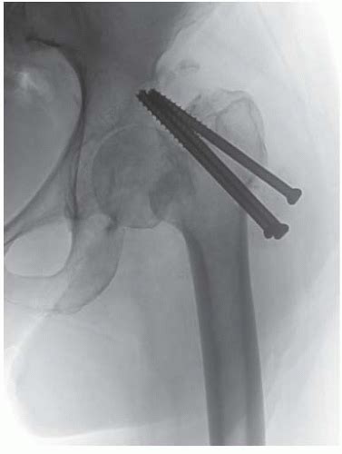 Femoral Neck Fractures Hemiarthroplasty And Total Hip Arthroplasty