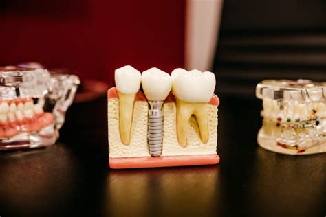 What Dental Implants Are Made Of Everything You Should Know The