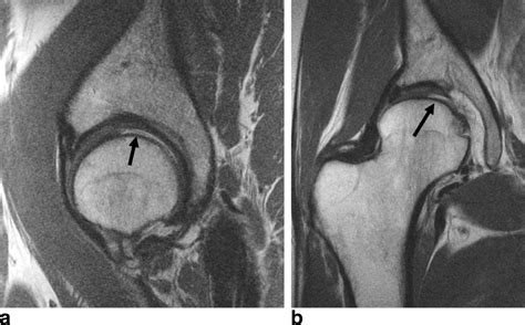 High Resolution Noncontrast Mri Of The Hip Potter 2010 Journal Of Magnetic Resonance