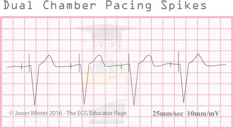 Pacemaker Ekg Strip