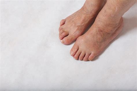 How Diabetes Affects Your Feet Daniel P Klein Md Facp Primary Care