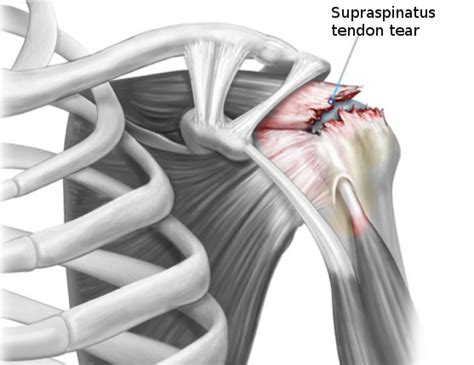 Rotator Cuff Tear Stretches