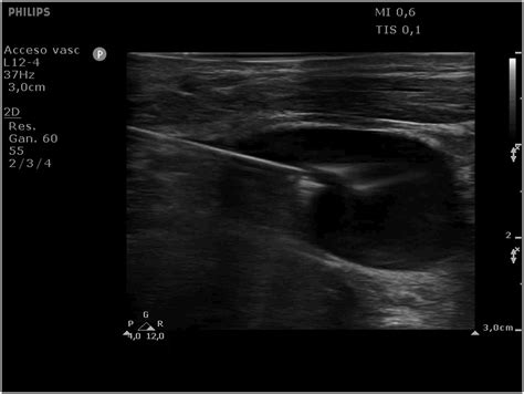 Short Axis In Plane Ultrasound Guided Technique For Internal Jugular