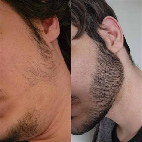 3 Months On Minoxidil Both Around 3 Weeks Of Growth Should I Trim