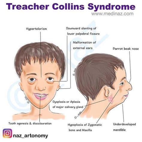 Síndrome De Treacher Collins Nhs Personalitytipsonline