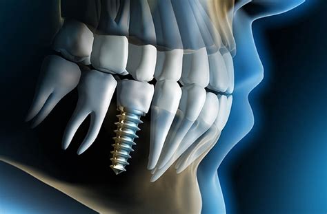 Clínica Odontológica Especialista em Implantes | Agende Sua Consulta