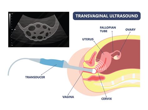 TVS Ultrasound - Transvaginal Scan Test Cost | Motherhood Fertility and ...