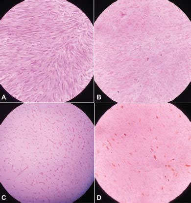 Hpe And Ihc Study A High Power View Showing Spindle Shaped Malignant