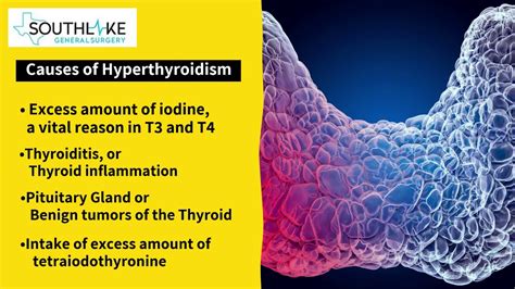 Hyperthyroidism Causes Symptoms Treatment Southlake General Surgery