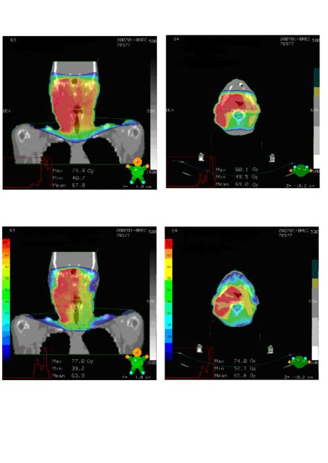 A Example Of A Plan For 3d Conformal Radiotherapy B Example Of A Download Scientific Diagram