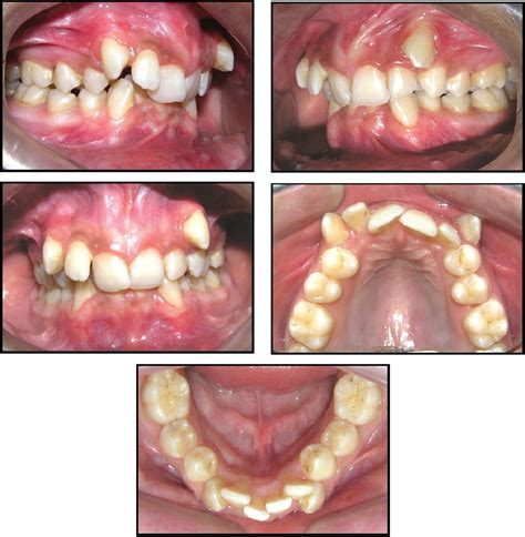 Case Report Correction Of Class Ii Div 2 Malocclusion With Maxillary Arch Extraction And Lower