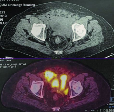 A B Left Bladder Mass Infiltrating Bilateral Distal Ureters And