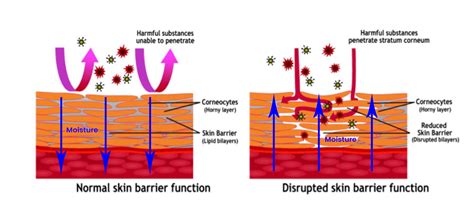 What Is Skin Barrier