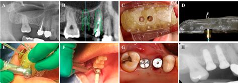 Figure From Accuracy And Feasibility Of A Zero Setup Implant Guide