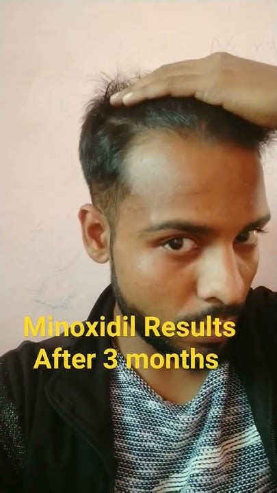 Minoxidil Results After 3 Month S Youtube