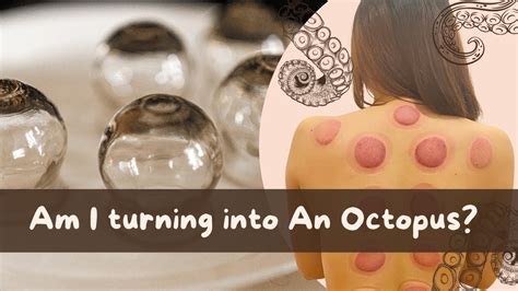 I Tried Cupping Therapy For The First Time Youtube