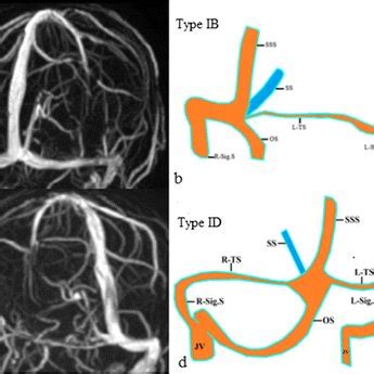 Evaluation of dural venous sinuses and confluence of sinuses via MRI ...