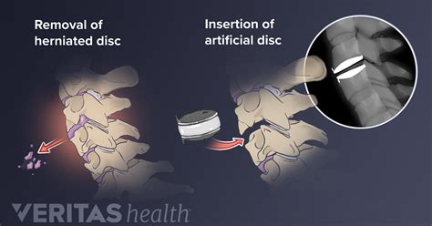 Evaluating Surgery For Artificial Disc Replacement