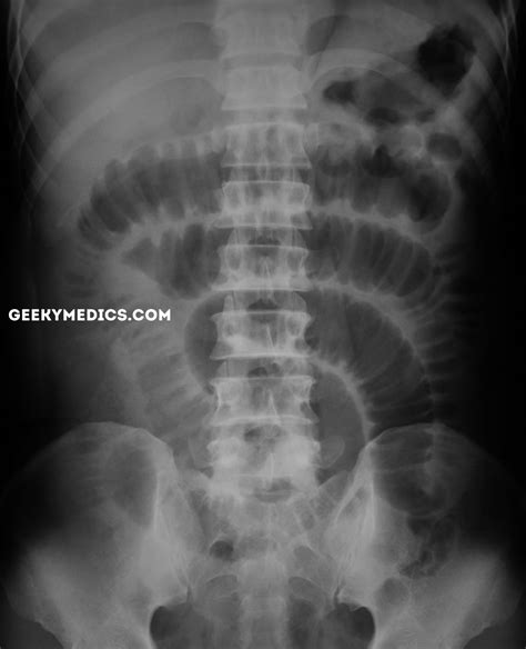 Bowel Obstruction Small Bowel Large Bowel Geeky Medics