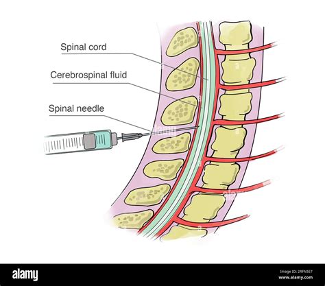 Lumbar Puncture Layers