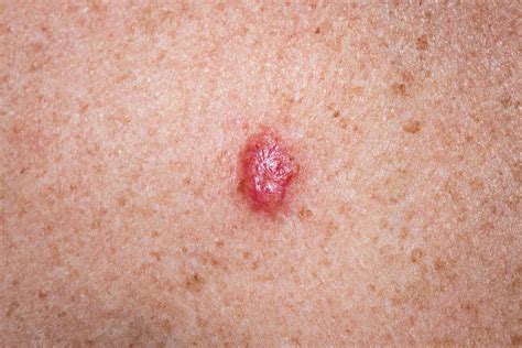 Tumori Della Pelle Non Melanoma Il Punto Sui Trattamenti