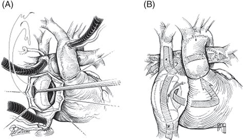 The Functionally Univentricular Heart Thoracic Key