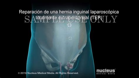 Intervención Quirurgica De Hernia Inguinal Youtube