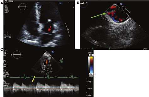 Cor Triatriatum A Transthoracic Echocardiogram Showing A Membrane In