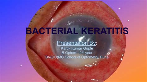 Bacterial Keratitis Ppt