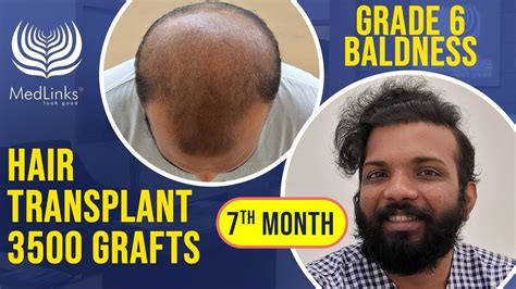 5000 Grafts Hair Transplant Cost India Shaunte Schafer