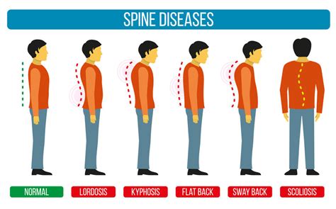 Tipos De Escoliosis