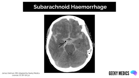 Types Of Intracranial Haemorrhage Bleeds Geeky Medics