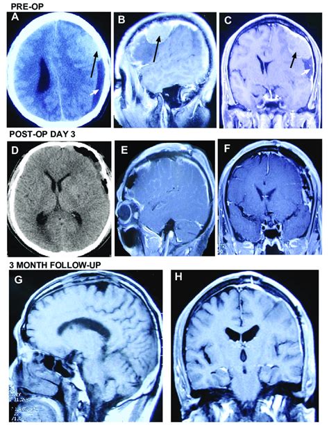 Preoperative Postoperative And Follow Up Images A Axial Ct Scan B