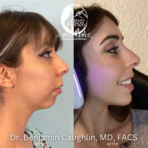 Combination Of Buccal Fat Removal Jawline Sculpting Chin Implant