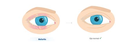 Edema Palpebral: causas y tratamiento | Blog de Clínica Baviera