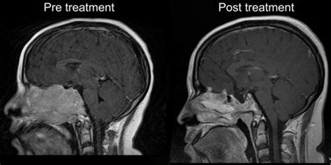 Invasive Giant Prolactinoma Presenting As A Nasal Polyp The Journal