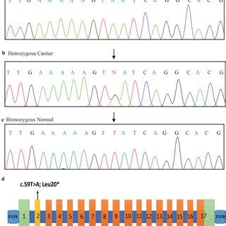 Electropherograms Representing Sanger Sequencing Of A Nonsense Variant