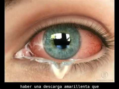 Descubre por qué te sale pus del ojo y las posibles causas detrás de