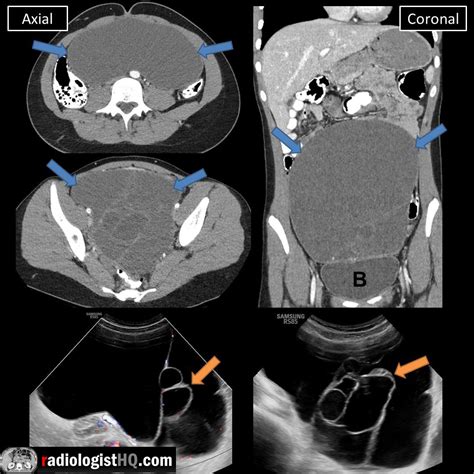 Mucinous Borderline Tumor Of Left Ovary On Ct And Ultrasound Rradiology