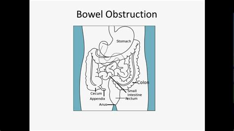 Bowel Obstruction Usmle Step 2 Review Youtube